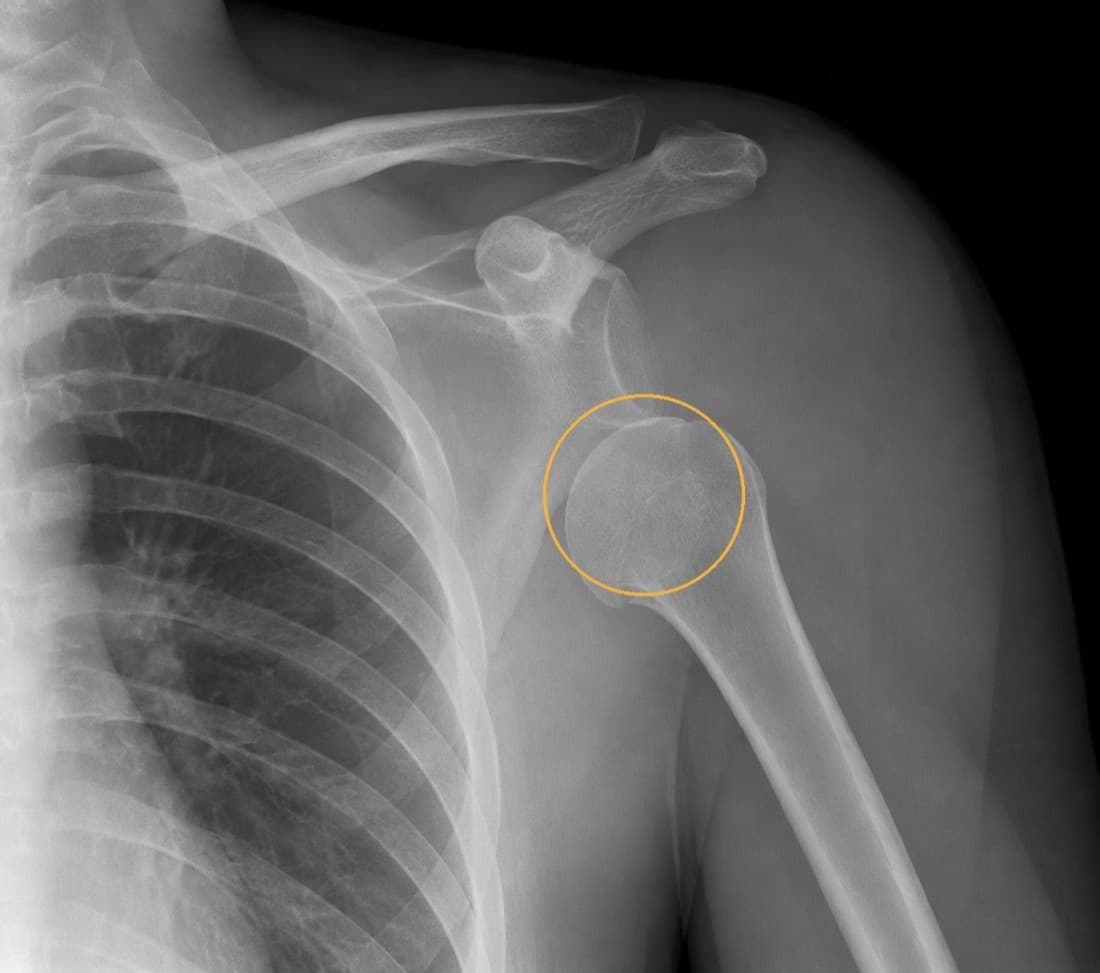 A shoulder radiograph with the dislocated humeral head circled, sitting forward and below the glenoid.
